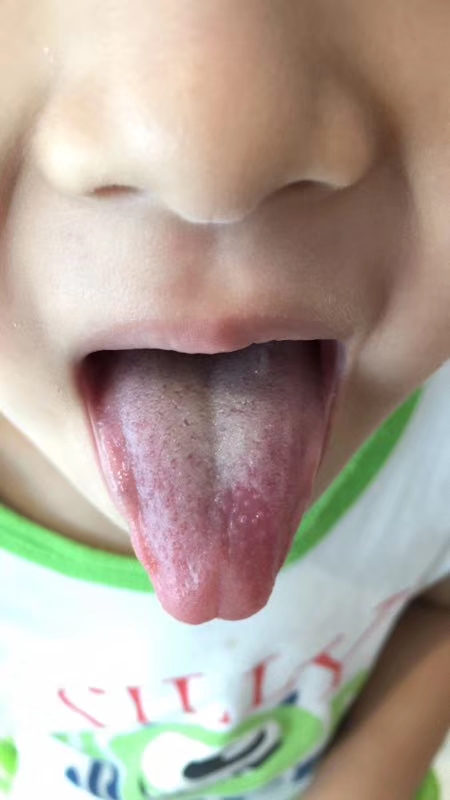 中医临床治疗扁桃体发炎医案,化脓性扁桃体炎中医辨证论治