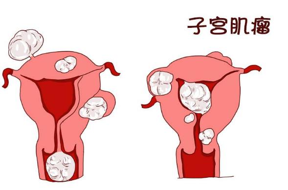 子宫肌瘤微创手术后多久可以备孕,子宫肌瘤会不会影响试管