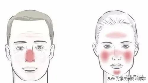 认识痘痘类型,玫瑰痤疮和激素脸哪个严重