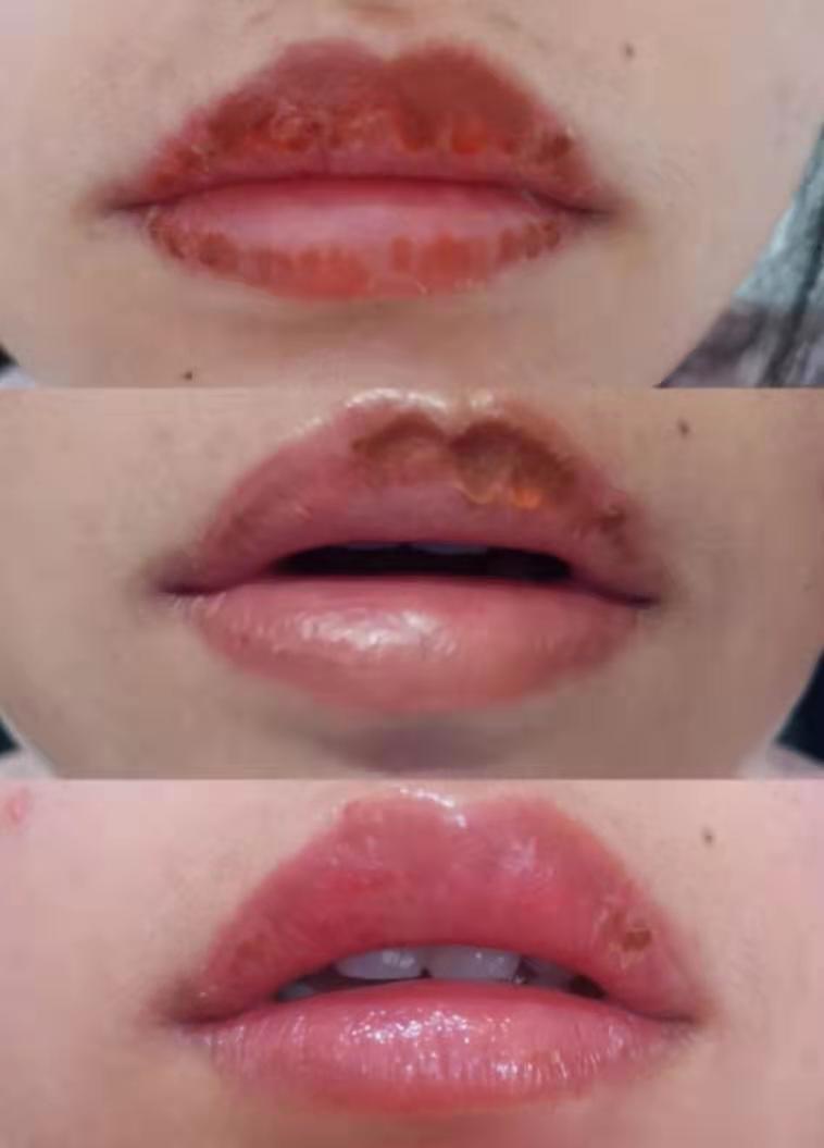 嘴巴干裂起皮推荐护唇油,秋冬季嘴唇干裂起皮这样涂