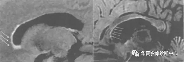 颅脑核磁影像解剖图谱,颅脑mr增强影像图片