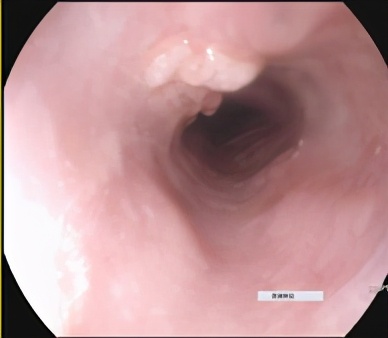 不可切除肺癌肿瘤治疗方法,不可切除晚期治疗什么意思