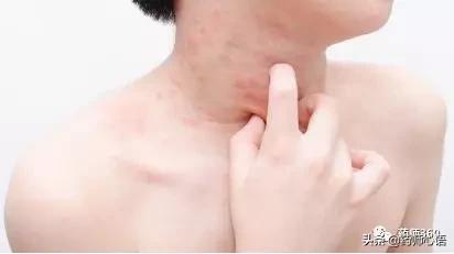 麻疹有什么中成药,常见人工荨麻疹的治疗方法有哪些