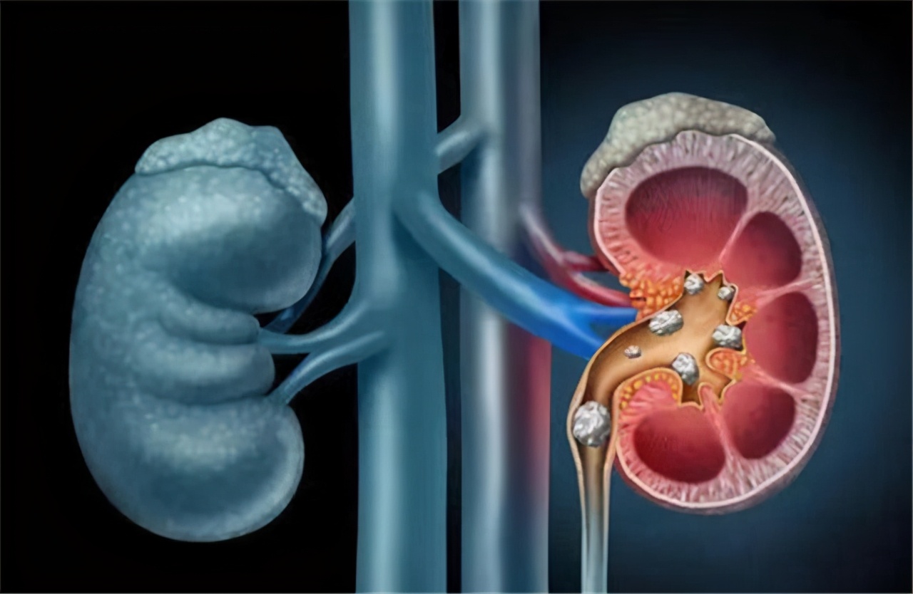 高血压会引起尿检隐血吗,高血压尿潜血是肾炎吗