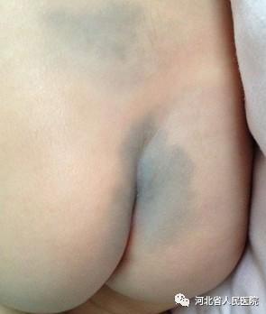 盘点新生儿特有的体征“符号”