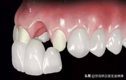 做的烤瓷牙根部发黑了怎么回事,烤瓷牙为什么牙根会变黑