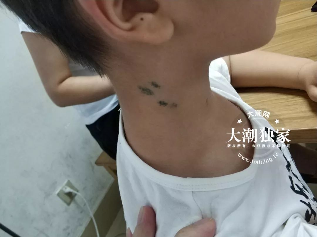 十岁小孩身上被扎12针,触目惊心的少年