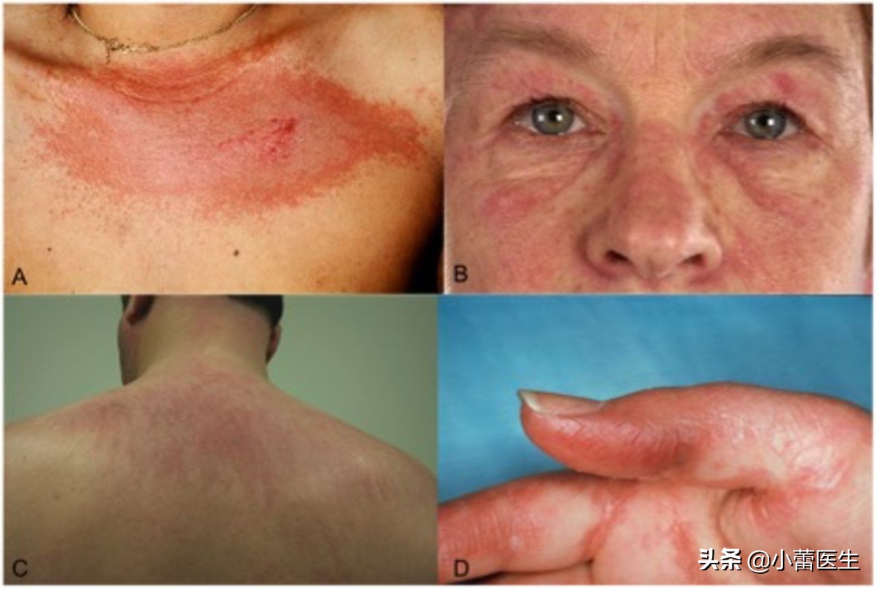 肩肌炎严重吗,从肩到后背疼痛是什么原因