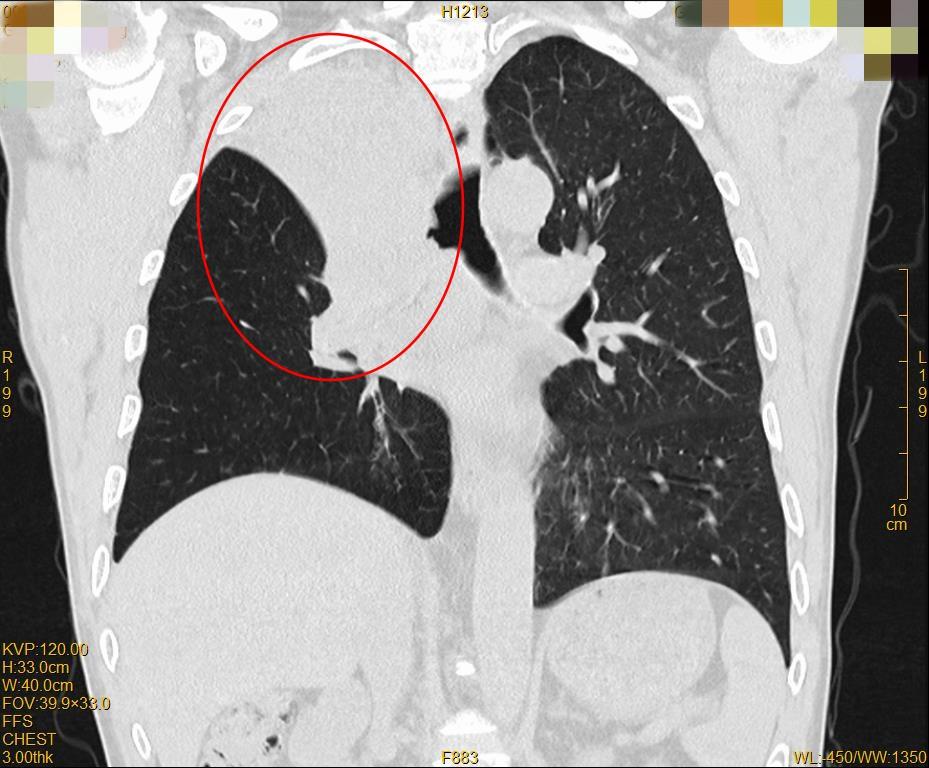 一束光杀灭癌细胞设备,一束光治疗癌症全国几家医院有