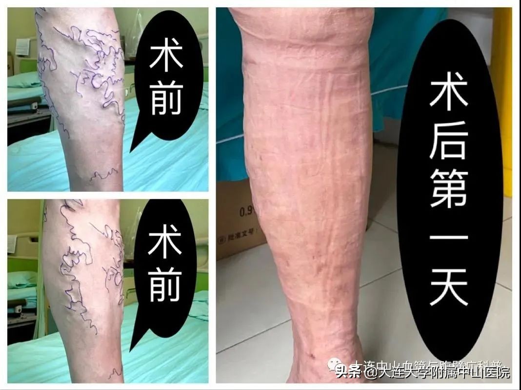 科普知识日间手术轻松搞定蚯蚓腿,日间手术知识科普