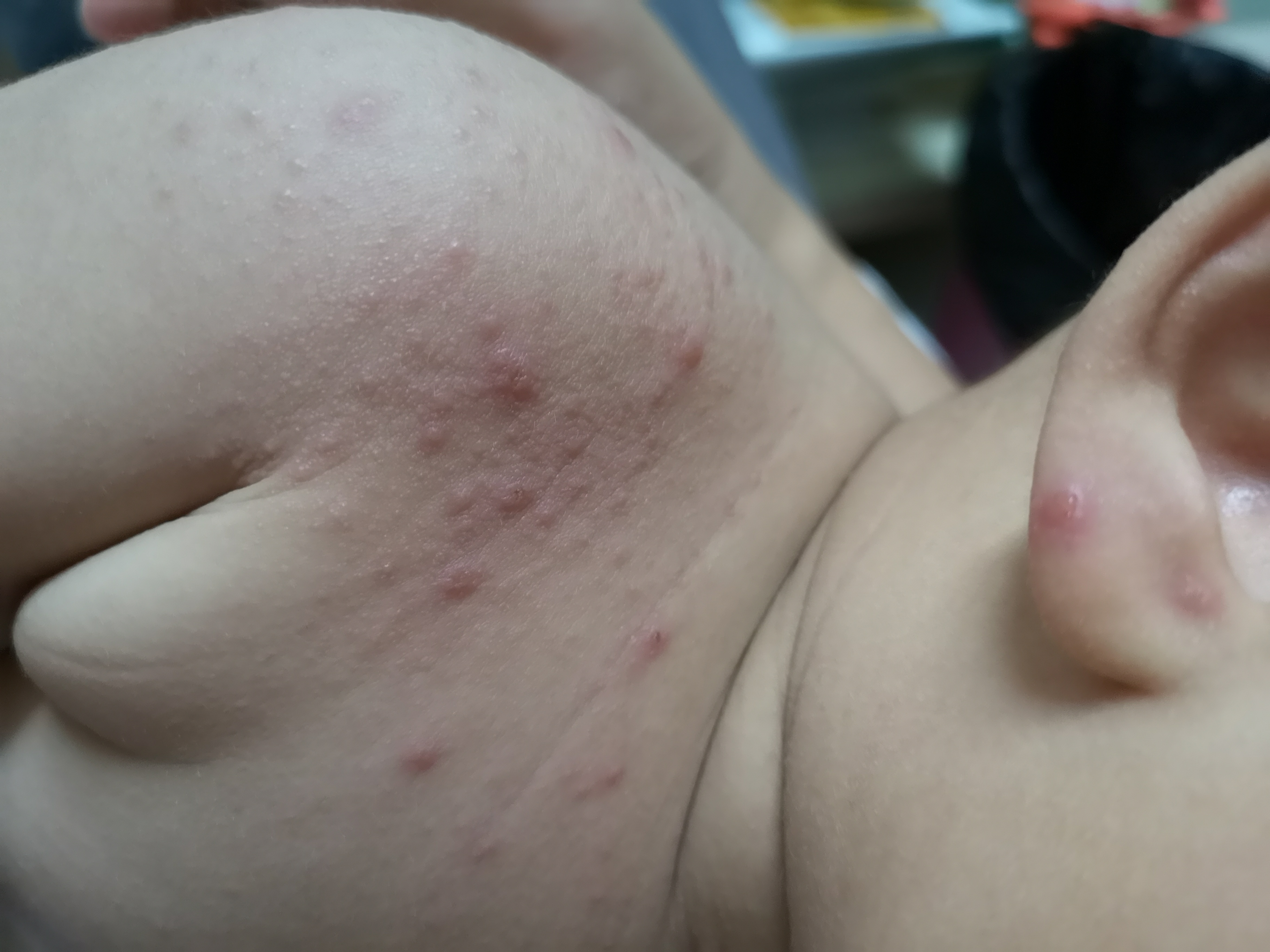 手足口疱疹性咽颊炎进入高发期,手足口高发期孩子有什么症状