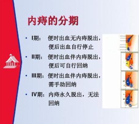 痔疮如何对症用药,肛肠科专家谈痔疮