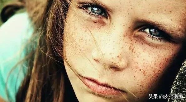 雀斑黄褐斑老年斑祛斑方法,褐斑老年斑怎么治疗效果最好