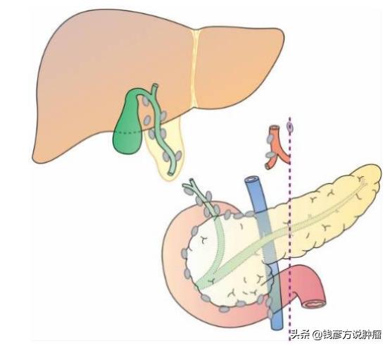 晚期肿瘤喝什么中药材调理身体,肿瘤晚期中医治疗最佳案例