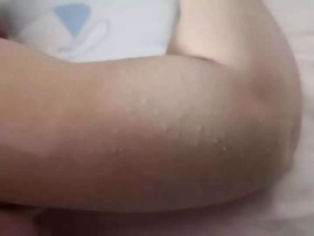 孩子长疹子、痰火核用不用吃药？