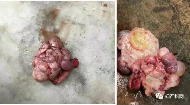 乳腺癌卵巢转移病例,乳腺癌病例分析ta2