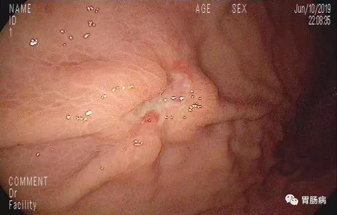 萎缩性胃炎与胃癌的关系,萎缩性胃炎与胃癌的症状区别