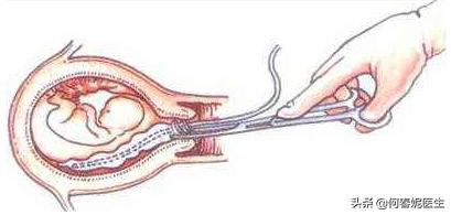 羊水过多过少对胎宝宝的影响,孕妈羊水少为什么会缺氧