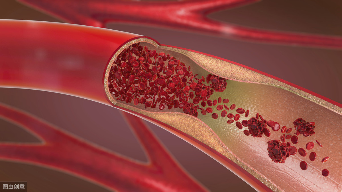 头晕血脂高,头晕是高血脂的症状吗