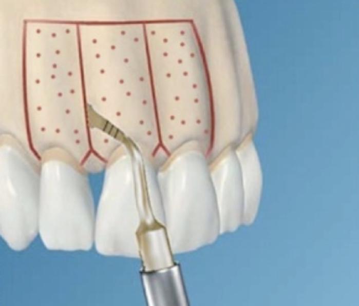 骨性龅牙怎么弄,如何判断骨性龅牙的轻重程度