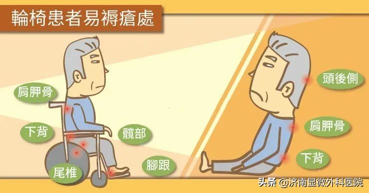 褥疮的预防和护理正确做法,得了压疮正确的护理方式