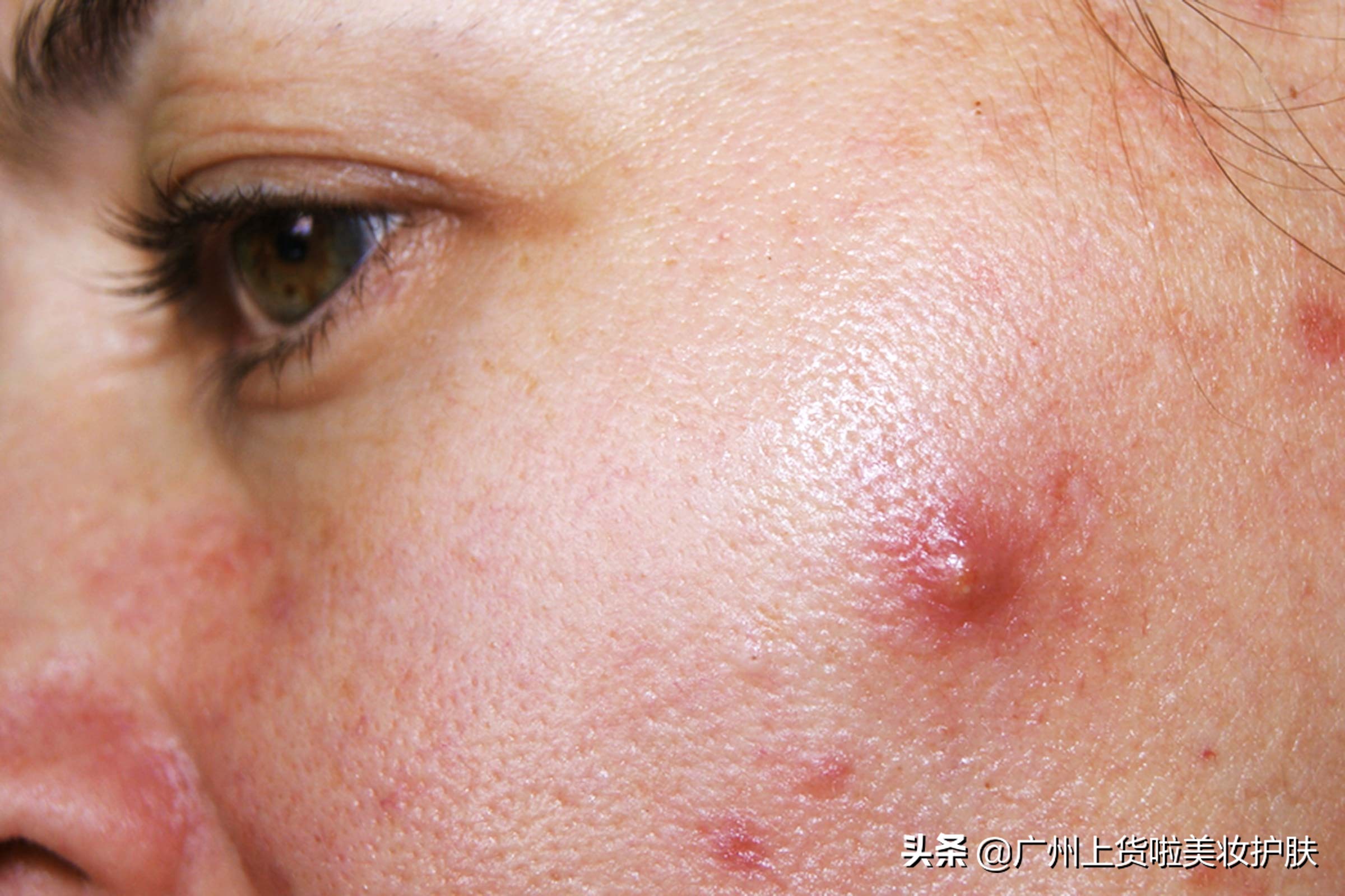 对付褐黑色痘印,对付黑痘印最有效的成分