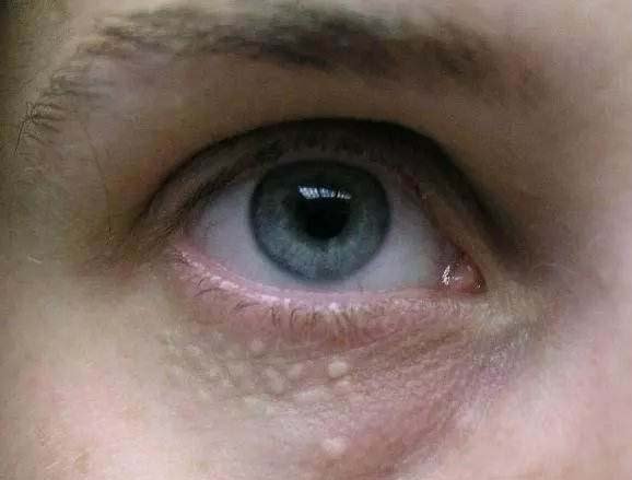 夏天出汗眼睛周围起疙瘩怎么回事,脸上眼睛周围有小米粒那样的疙瘩