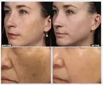 东星祛斑霜为什么火了,东星祛斑霜是真的吗