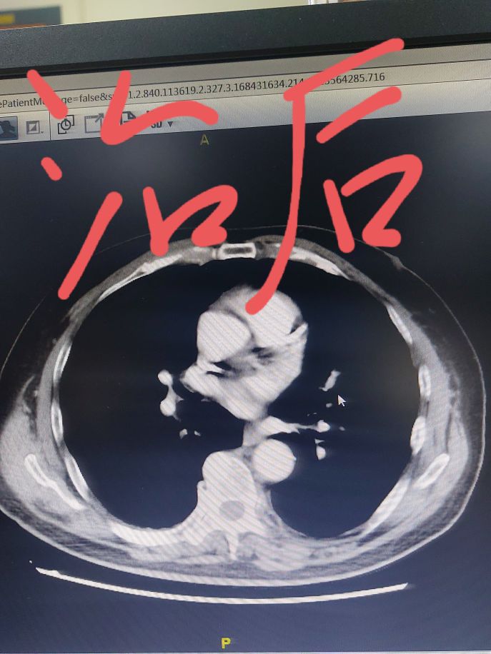 刘懿谈肺癌治愈率,刘懿谈肺癌病理报告