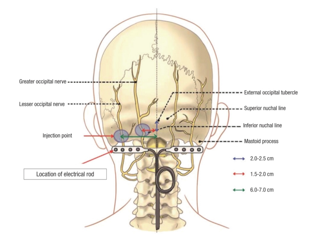 头痛都是神经性的吗,怎么判断是颈椎引起的头痛
