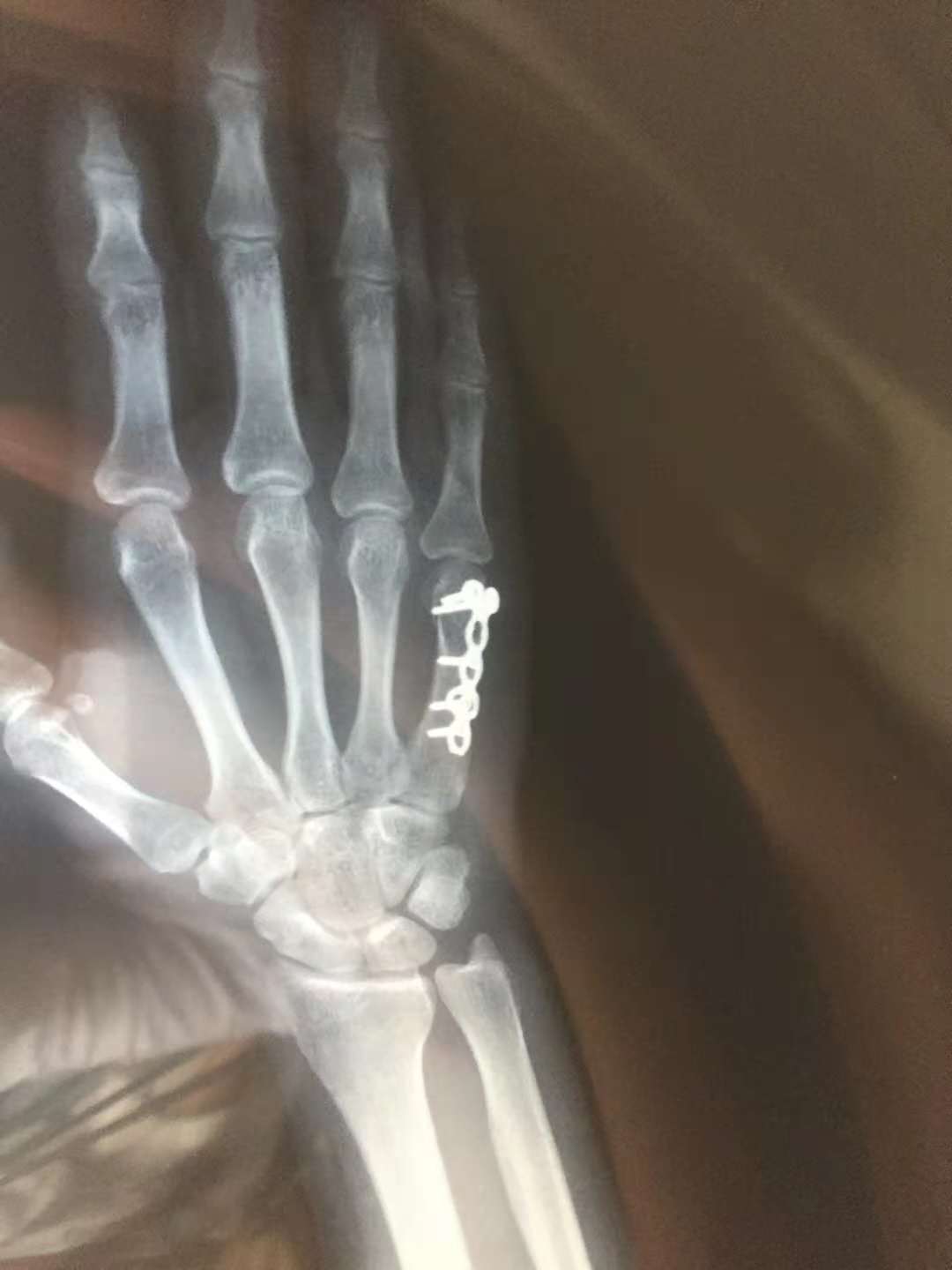 拳击手骨折手背凸起,了解什么是拳击手骨折