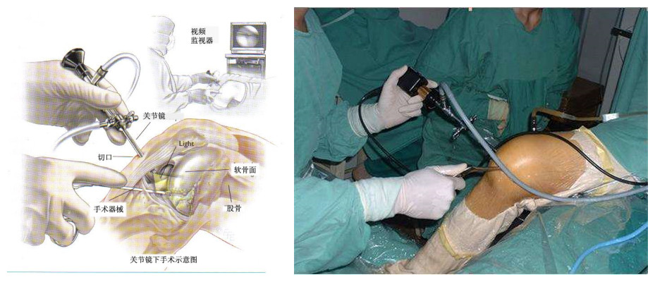 滑膜炎来袭，还有什么可以阻挡？