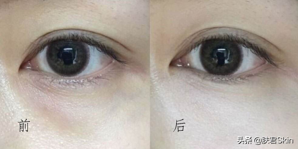 有什么沟必须火的,泪沟后面有一条很深的沟叫什么