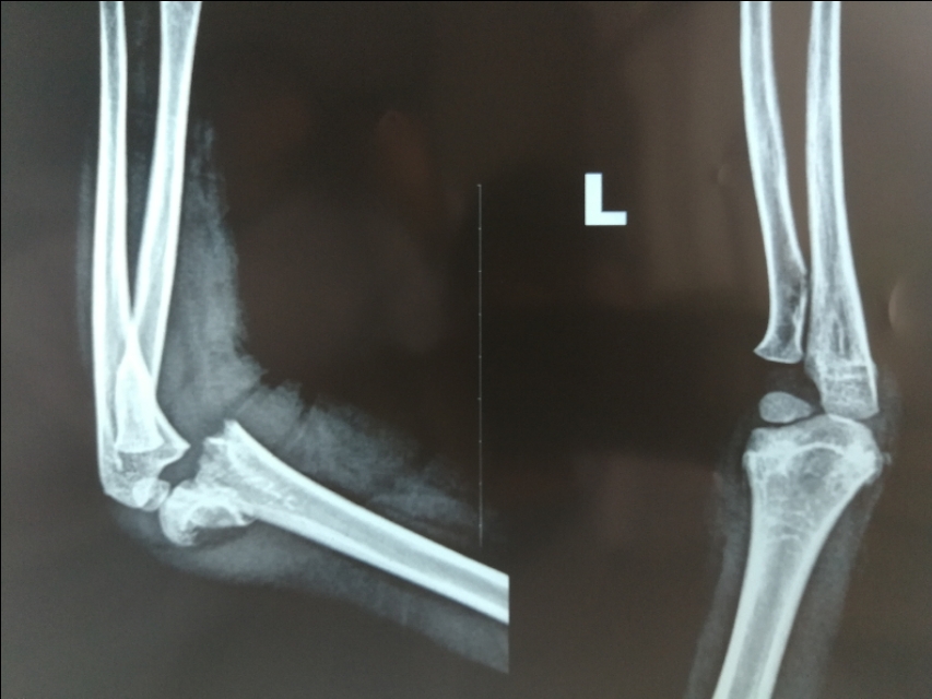 骨折的微创手术有后遗症吗,骨折的微创手术需要多少钱