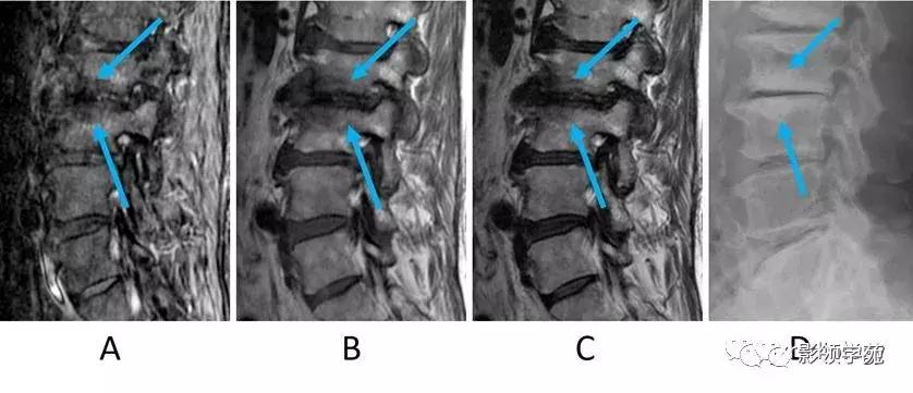 9种椎体和椎旁信号增高的非肿瘤性病变