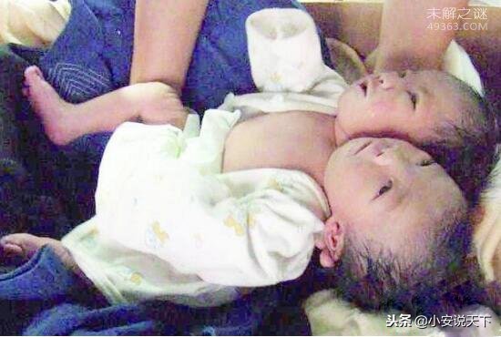 巴西双头婴儿,巴西双头婴儿后续