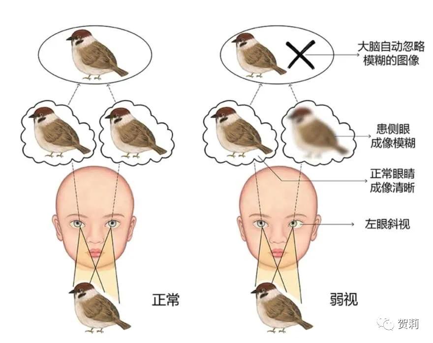 孩子单眼弱视要遮盖吗,弱视正确遮盖法