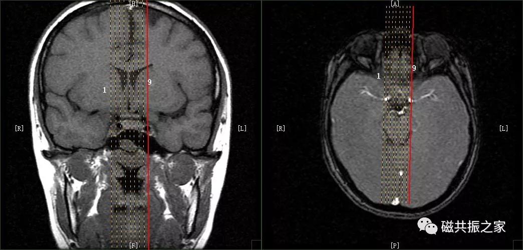 垂体mri扫描,垂体微腺瘤mri扫描