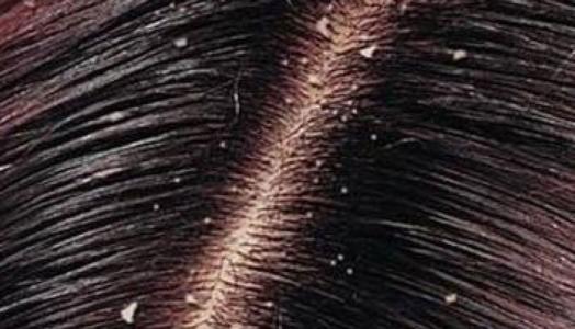 头上头皮屑越抓越多,头上头皮屑多头皮一挠就破