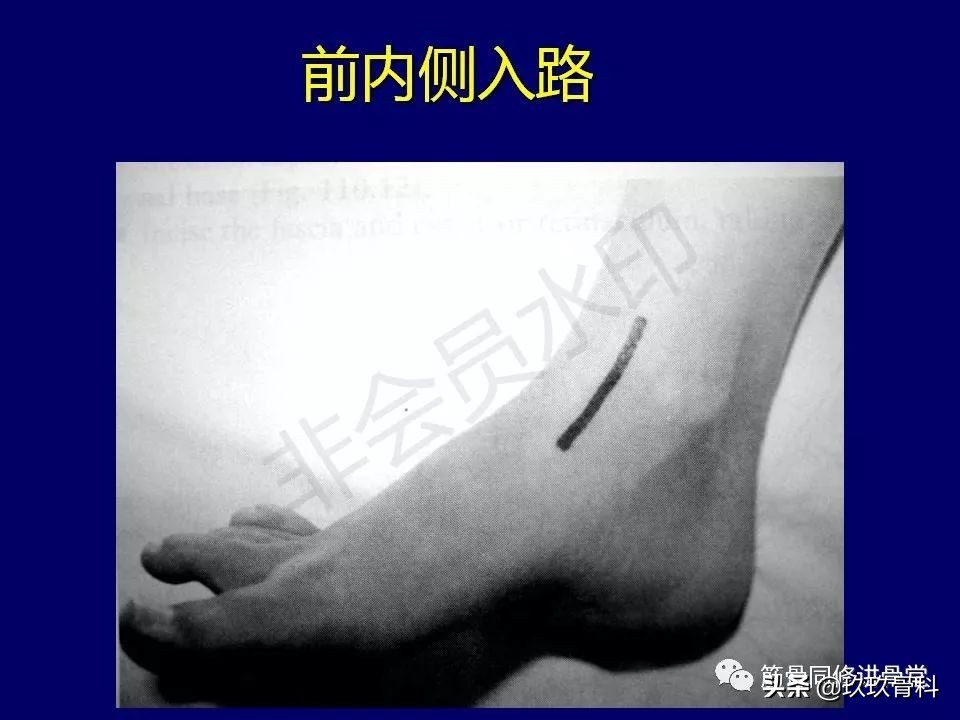 距骨骨折后遗症,距骨骨折怎么办