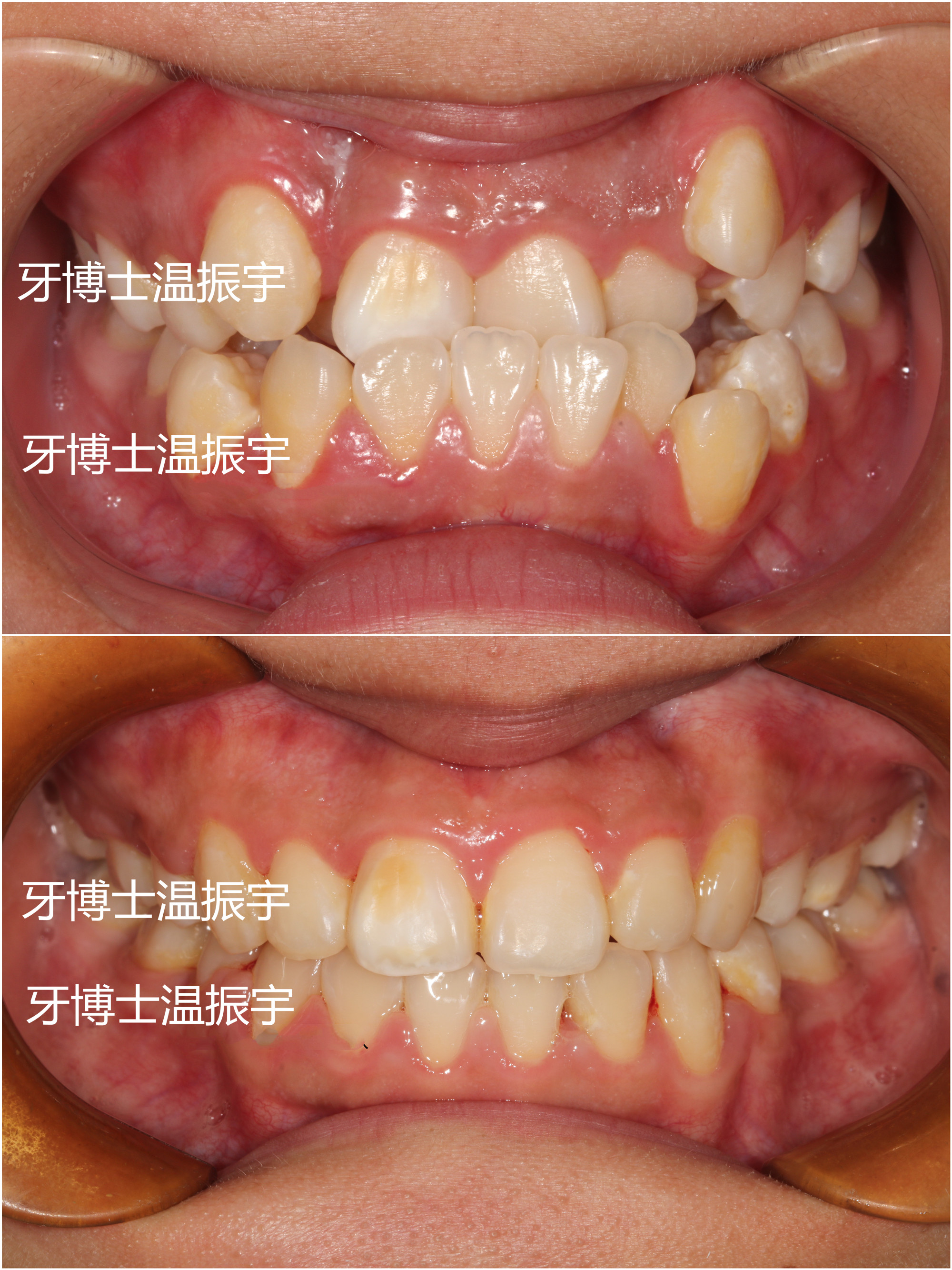 30岁还可以牙齿矫正吗,30岁牙齿矫正一般多少钱