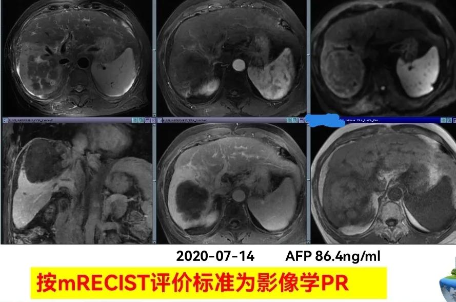 肝癌晚期靶向治疗怎么做,中国肝癌tace治疗展望