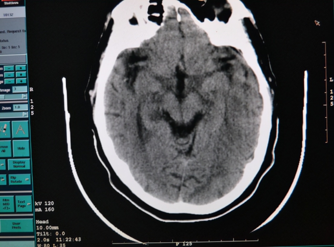 高血压导致脑出血怎么救治,高血压脑出血应该如何救治