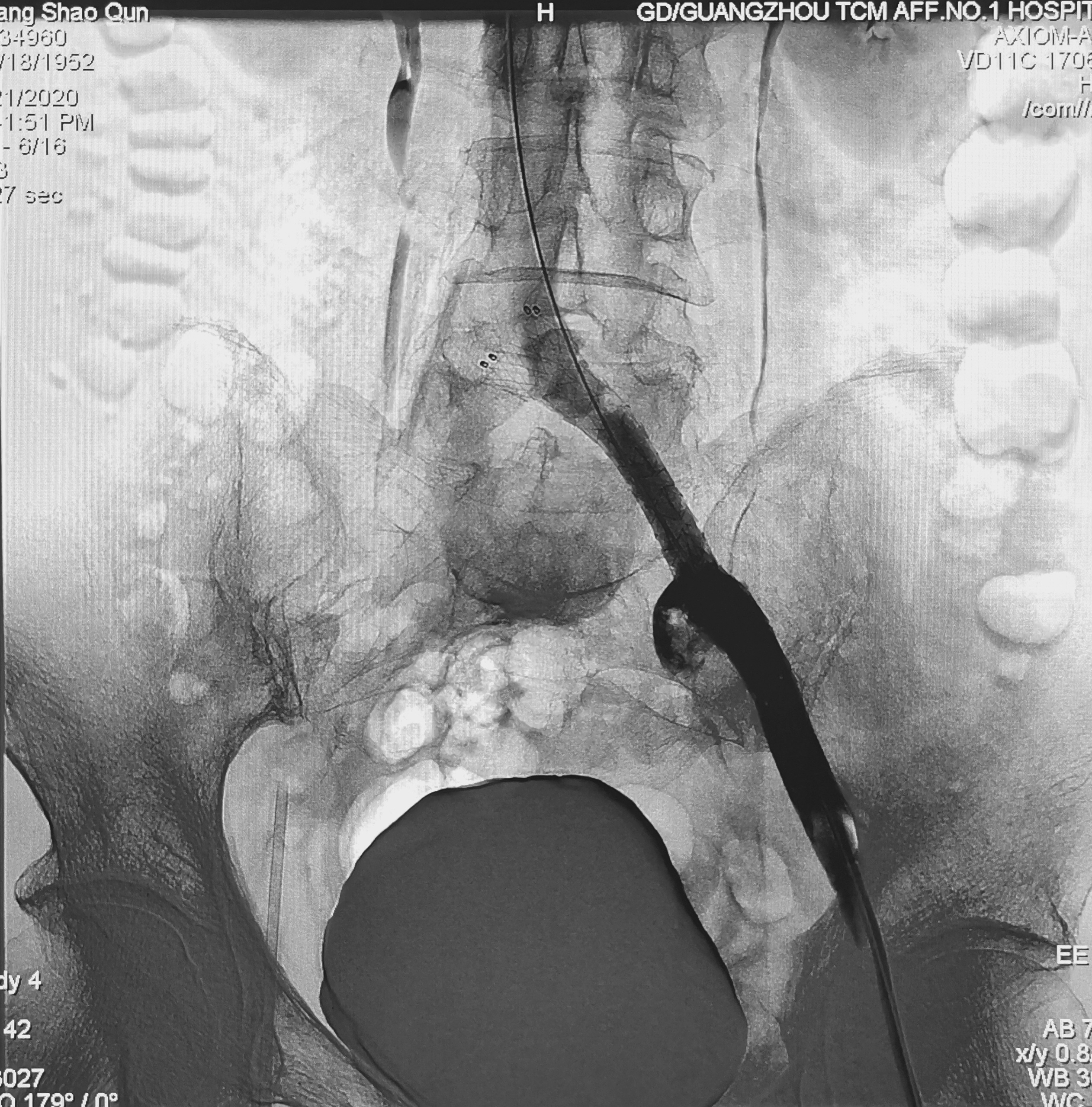 动脉压迫静脉什么原因,下肢动脉闭塞会引起小腿肿吗