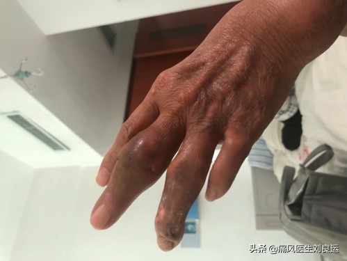 尿酸正常了可以手术取痛风石吗,痛风石可以做手术取掉吗