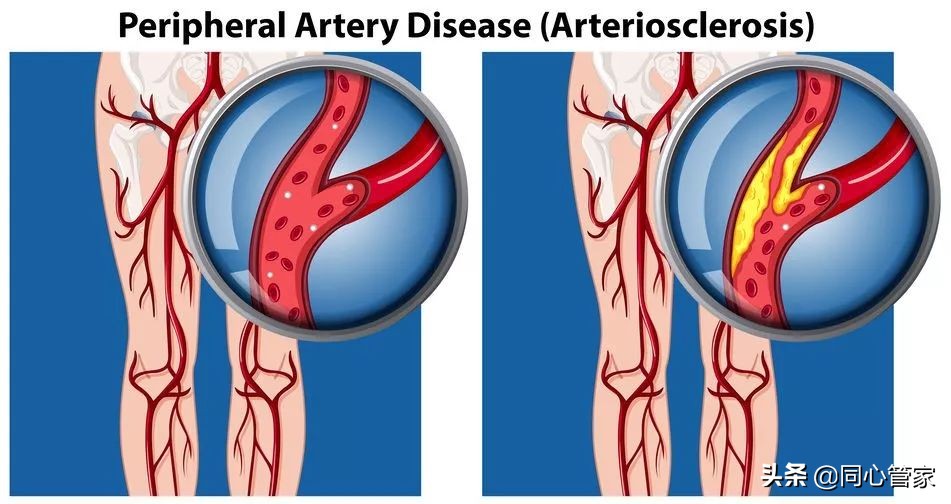 血管狭窄如何扼住生命的咽喉？让你全身器官都遭殃？
