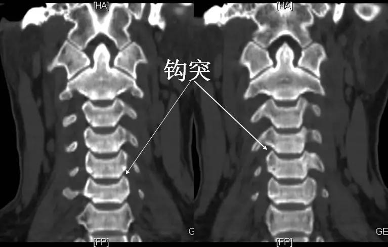 颈椎腰椎疾病ct及mri诊断,腰椎ct可以发现肠部病变吗