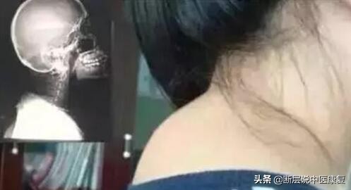 10岁小孩脖子后面有富贵包,脖子后面富贵包怎么彻底消除