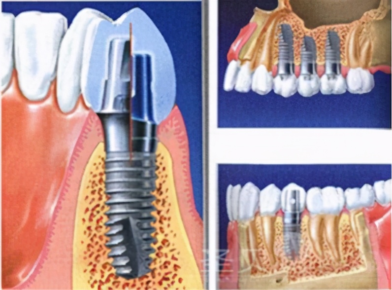 韩国与美国的牙种植体哪个好,韩国与国产的牙种植体的差别