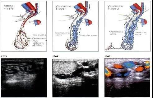 北京301医院做精索静脉曲张手术,精索静脉曲张手术15000能报销多少